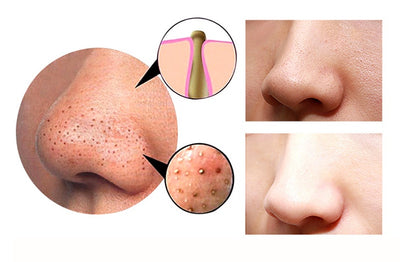 4 IN 1 Blackhead Remover & Pore Vacuum