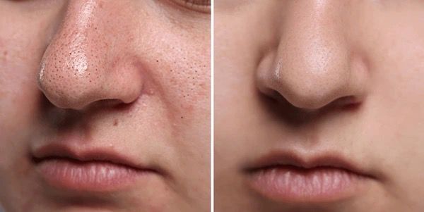 Rechargeable Pore Vacuum – Blackhead Remover Tool